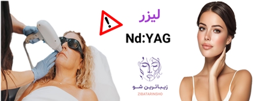 لیزر Nd:YAG