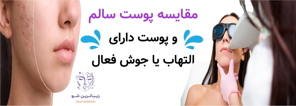 آماده سازی پوست قبل از لیزر موهای زائد، مقایسه پوست سالم و پوست دارای التهاب یا جوش فعال