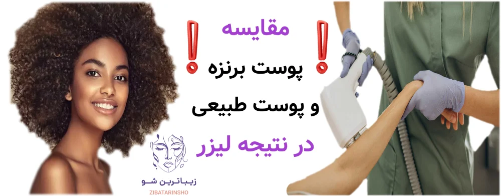 آماده سازی پوست قبل از لیزر موهای زائد، مقایسه پوست برنزه و پوست طبیعی در نتیجه لیزر