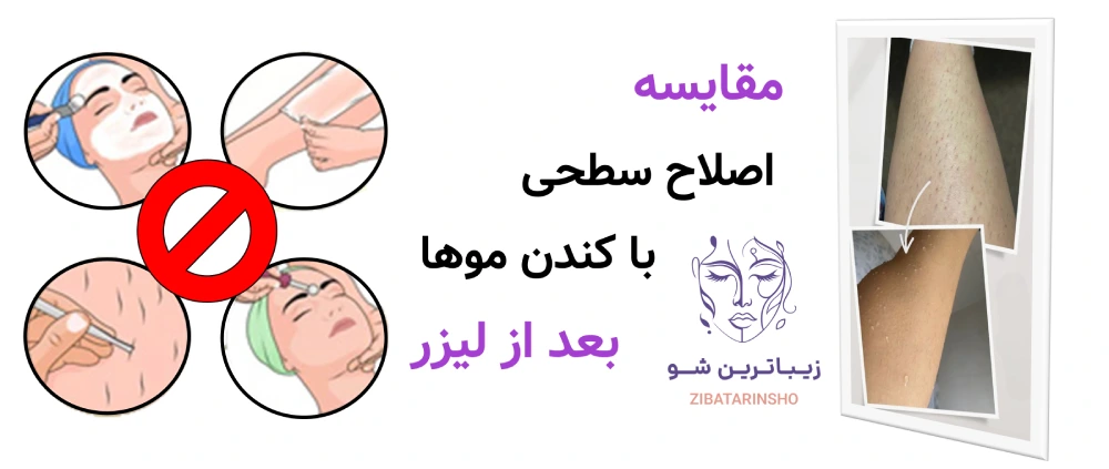 مراقبت های بعد از لیزر موهای زائد، مقایسه اصلاح سطحی با کندن موها بعد از لیزر