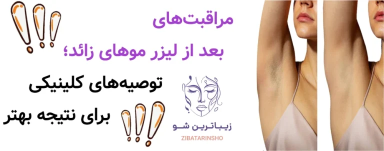 مراقبت‌های بعد از لیزر موهای زائد؛ توصیه‌های کلینیکی برای نتیجه بهتر