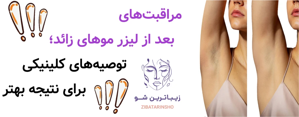 مراقبتهای بعد از لیزر موهای زائد؛ توصیههای کلینیکی برای نتیجه بهتر