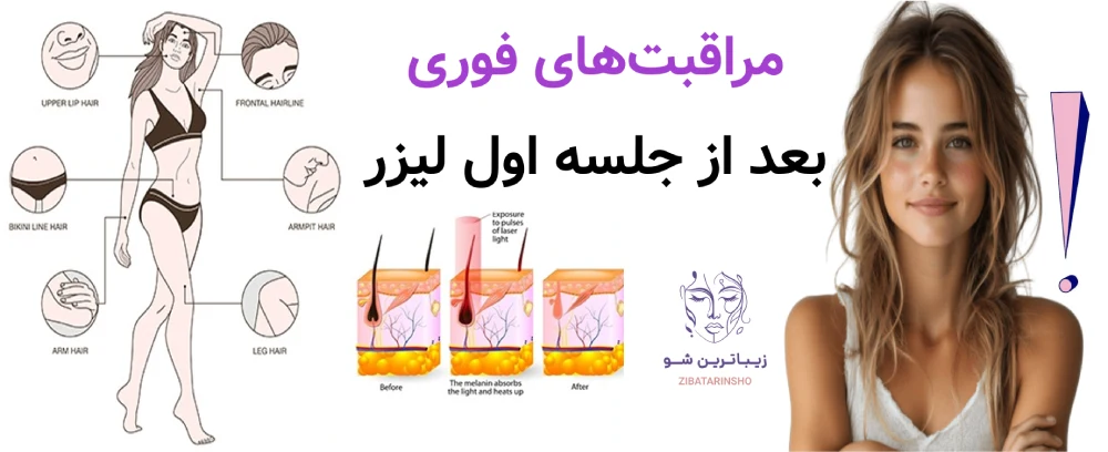 مراقبت های فوری بعد از جلسه اول لیزر