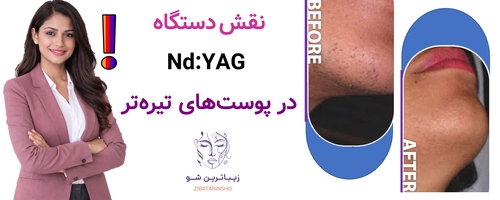 نقش دستگاه Nd:YAG در پوستهای تیرهتر
