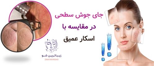جای جوش سطحی در مقایسه با اسکار عمیق