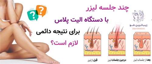 چند جلسه لیزر با دستگاه الیت پلاس برای نتیجه دائمی لازم است؟