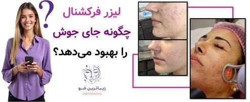 لیزر فرکشنال چگونه جای جوش را بهبود میدهد؟