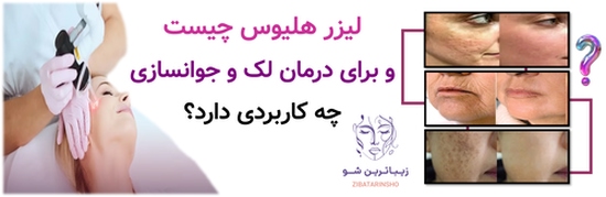 لیزر هلیوس چیست و برای درمان لک و جوانسازی چه کاربردی دارد؟