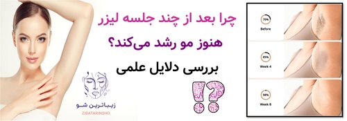 چرا بعد از چند جلسه لیزر هنوز مو رشد می‌کند؟ بررسی دلایل علمی