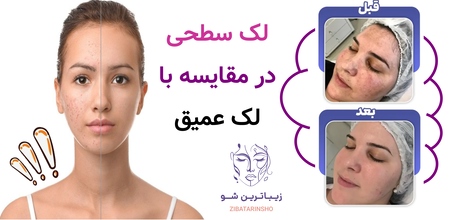 لک سطحی در مقایسه با لک عمیق