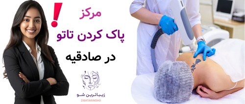 مرکز پاک کردن تاتو در صادقیه