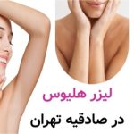 لیزر هلیوس در صادقیه تهران