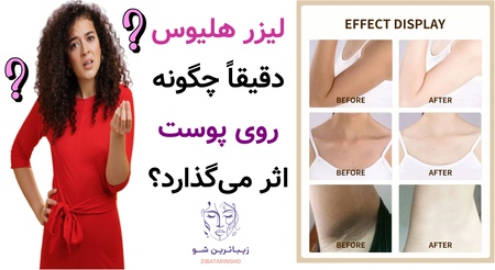 لیزر هلیوس دقیقاً چگونه روی پوست اثر میگذارد؟