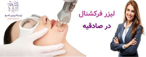 لیزر فرکشنال در صادقیه