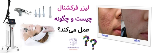 لیزر فرکشنال چیست و چگونه عمل میکند؟
