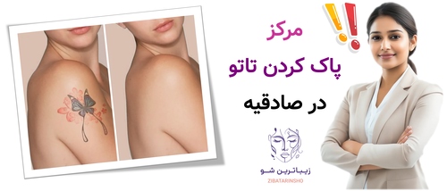 مرکز پاک کردن تاتو در صادقیه