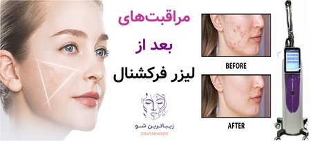 مراقبتهای بعد از لیزر فرکشنال
