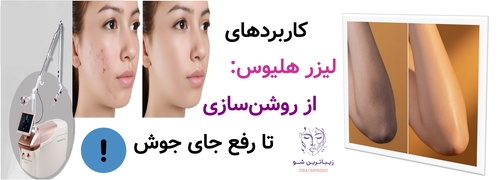 کاربردهای لیزر هلیوس: از روشنسازی تا رفع جای جوش