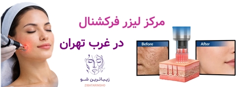 مرکز لیزر فرکشنال در غرب تهران