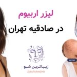 لیزر اربیوم در صادقیه تهران