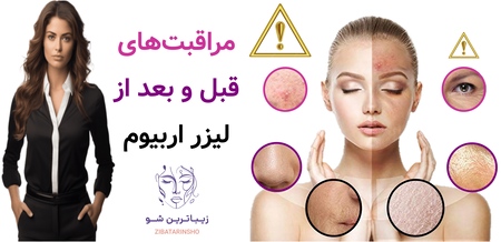 مراقبتهای قبل و بعد از لیزر اربیوم