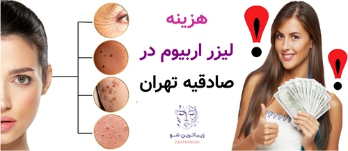 هزینه لیزر اربیوم در صادقیه تهران