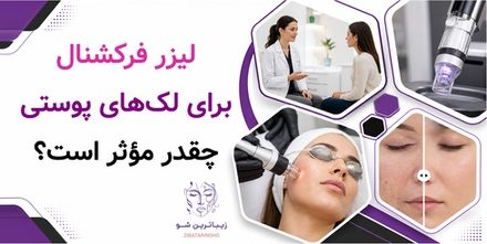 لیزر فرکشنال برای لکهای پوستی چقدر مؤثر است؟