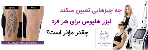 چه چیزهایی تعیین میکند لیزر هلیوس برای هر فرد چقدر مؤثر باشد؟