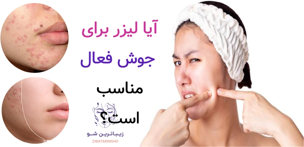 لیزر co2 فرکشنال یا اربیوم؛ کدام برای جای جوش و اسکار بهتر است؟