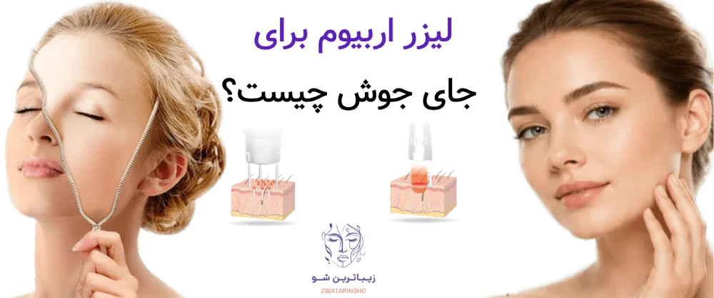 لیزر co2 فرکشنال یا اربیوم؛ کدام برای جای جوش و اسکار بهتر است؟ 